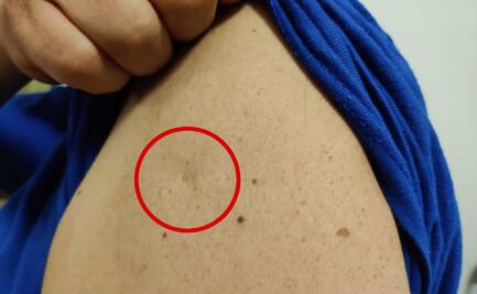 Si tienes esta cicatriz en el brazo, podrías tener inmunidad a la viruela símica