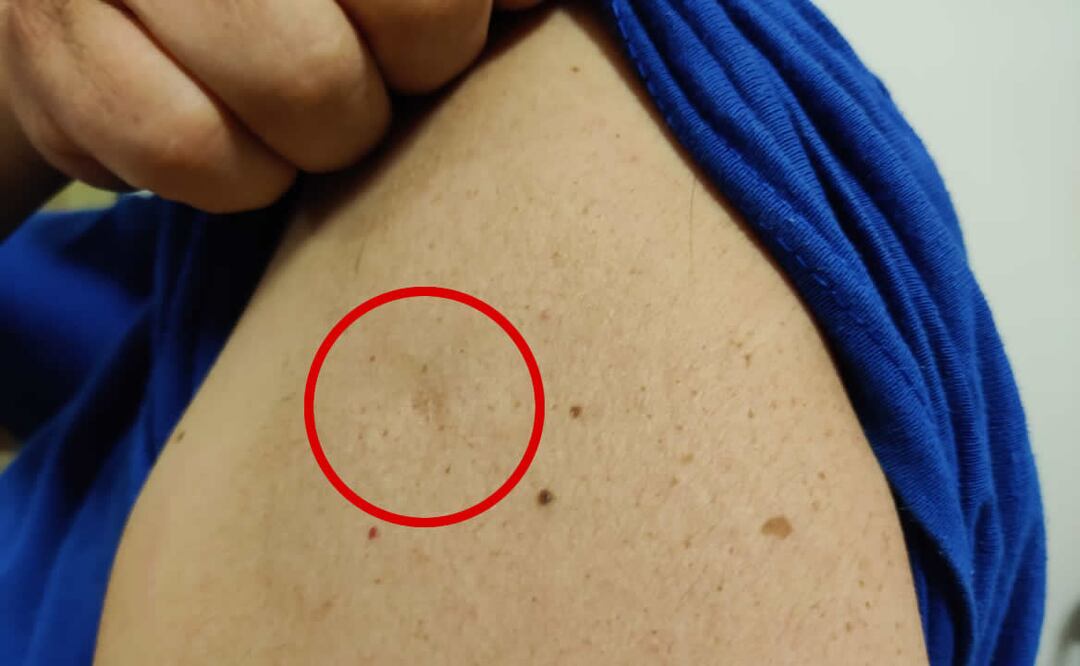 La vacuna de la viruela se dejó de aplicar en México en los años 80. Foto: EL UNIVERSAL PUEBLA