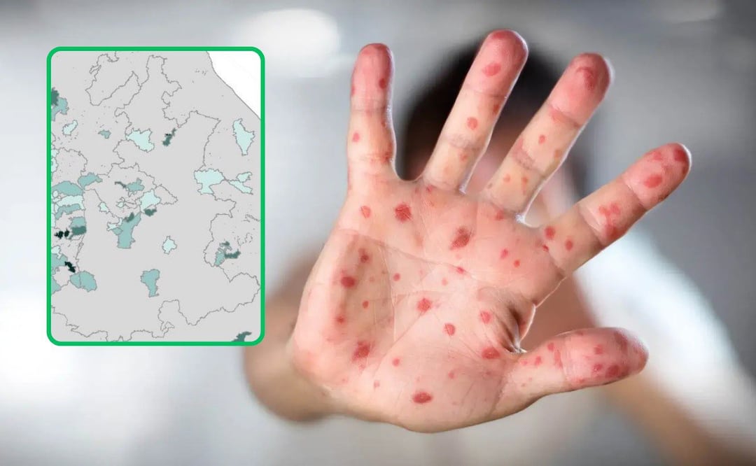 El sarampión está presente en 10 municipios de Puebla | Foto: Tec de Monterrey/Secretaría de Salud federal