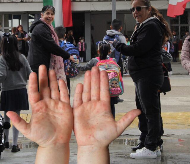 Gobierno de Puebla emite alerta por propagación del virus Coxsackie en escuelas