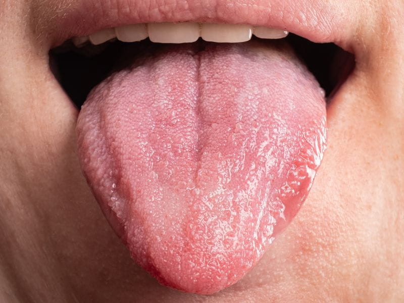 Si la capa blanca en la lengua persiste o empeora, lo mejor es consultar a tu dentista para recibir orientación adecuada.

Foto: Producción El Universal Puebla
