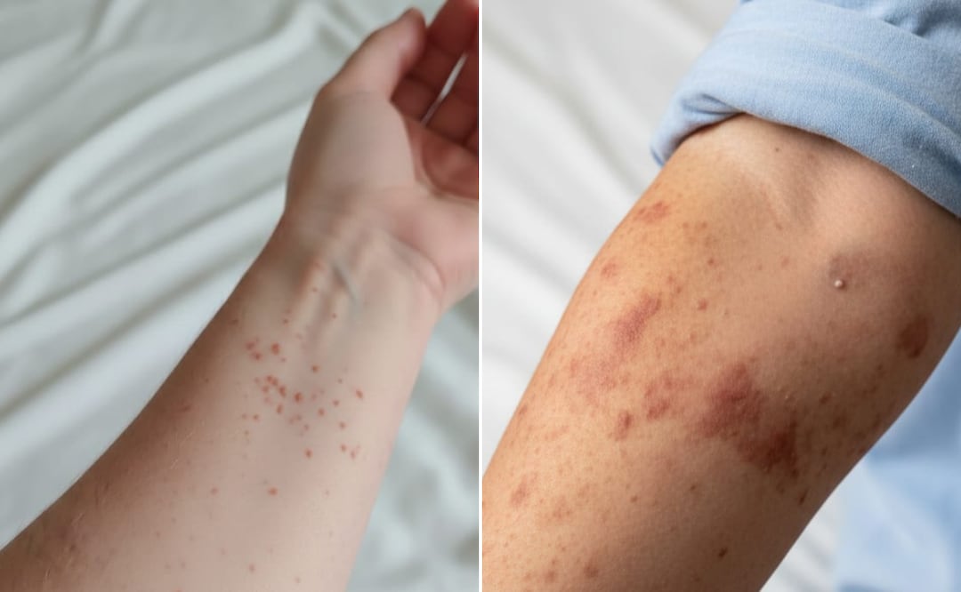 Confirman primer caso de sarampión en Puebla; cómo se contagia y cuáles son los síntomas I Foto: Gobierno del Estado