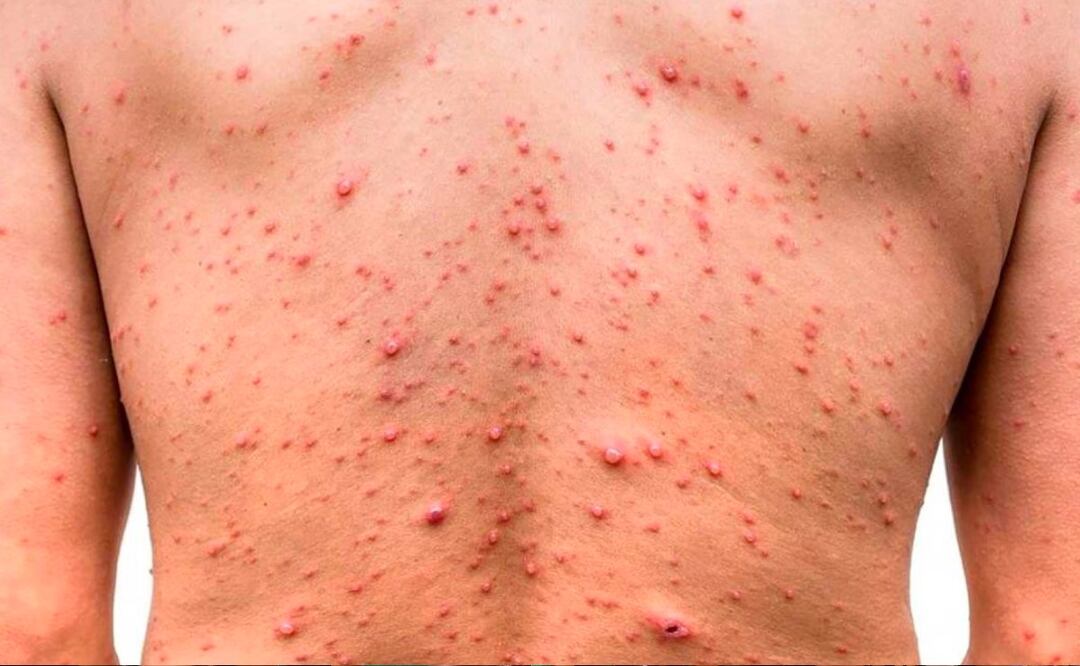Puebla se ubica dentro de los 10 primeros lugares a nivel nacional por contagios de viruela símica | IMAGEN: Especial