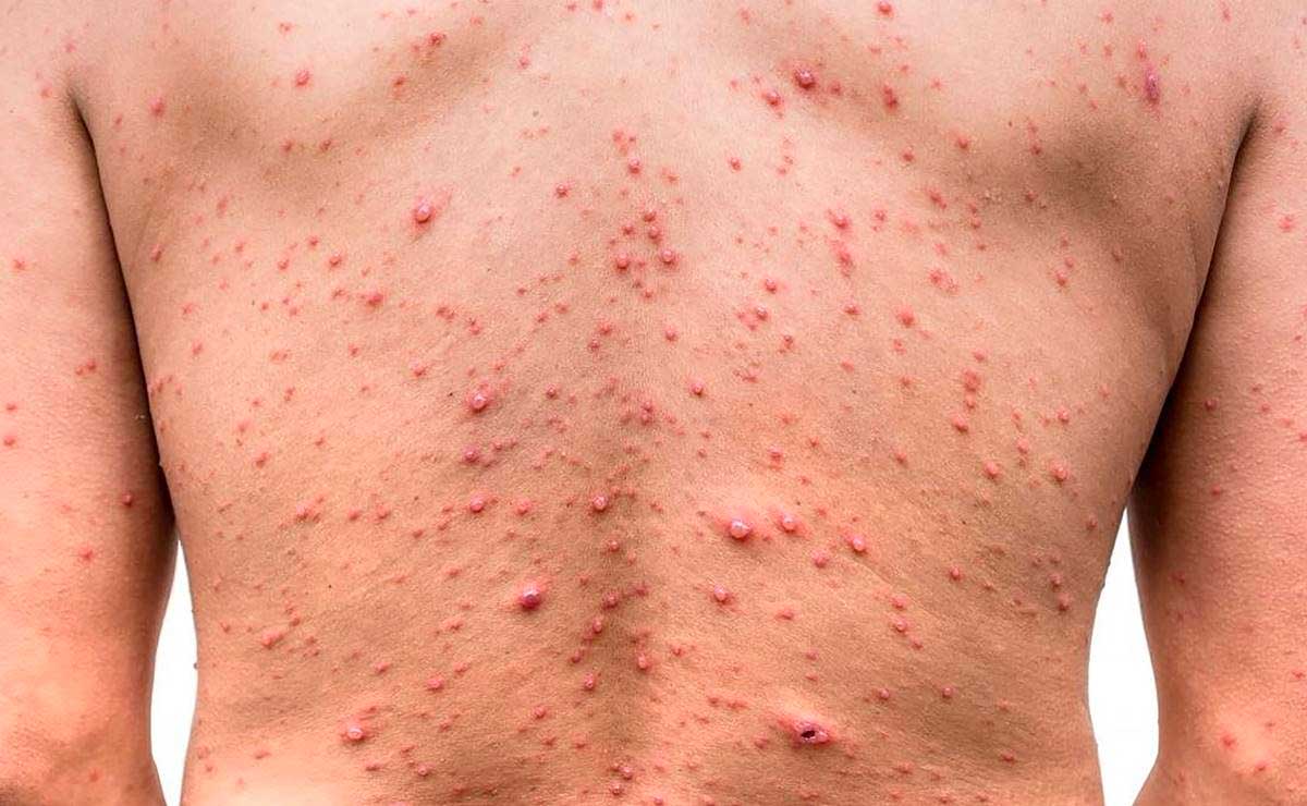 Hay dos casos de viruela del mono en Puebla