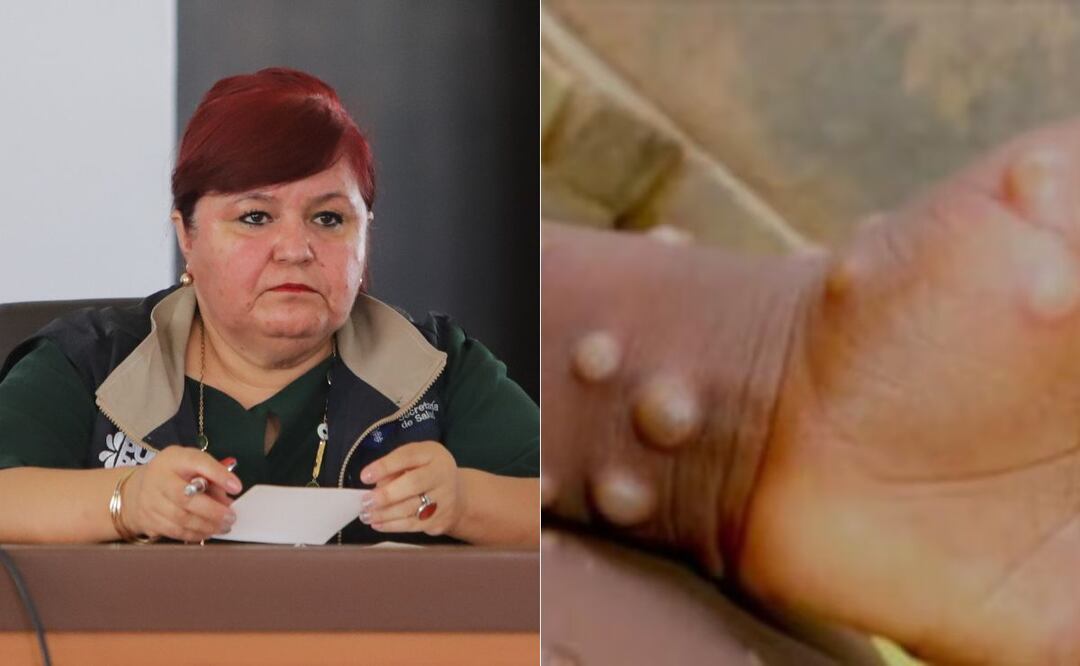 La Secretaría de Salud de Puebla aseguró que no hay casos de mpox en el estado | Foto: EsImagen / Archivo El Universal