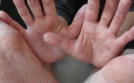 419 estudiantes de 77 escuelas de Puebla están infectados con virus Coxsackie