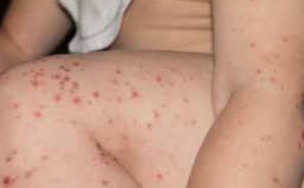 Qué es el virus de coxsackie que infectó a niños de una primaria de Tehuacán