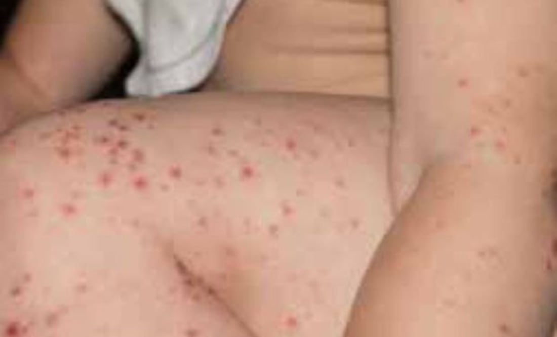 Se detectaron dos casos de Coxsackie en el Jardín de Niños “Frida Kahlo” | Foto: eipediatría.com