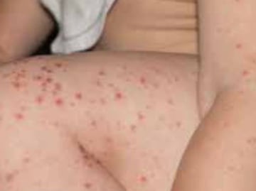 Qué es el virus de coxsackie que infectó a niños de una primaria de Tehuacán