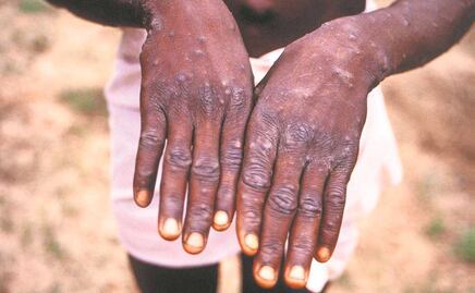 Activan alerta sanitaria en Puebla por la viruela del mono