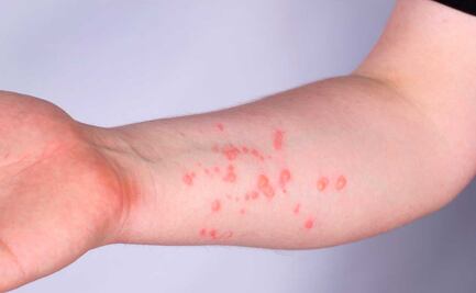 Aumentan casos de viruela símica en Puebla: hay 5 confirmados y 8 sospechosos