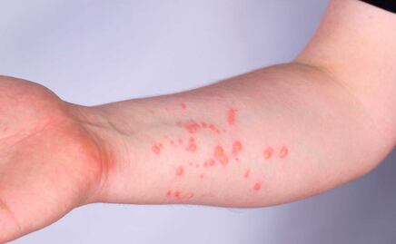 Aumentan casos de viruela símica en Puebla: hay 5 confirmados y 8 sospechosos