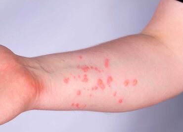 Aumentan casos de viruela símica en Puebla: hay 5 confirmados y 8 sospechosos