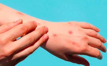 ¿Cuánto tiempo dura la viruela del mono?