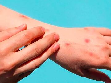 ¿Cuánto tiempo dura la viruela del mono?