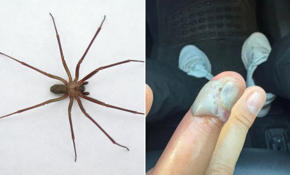 Una negligencia médica en Puebla puso en peligro la vida de un joven picado por una araña violinista | Foto: Gobierno de México / Facebook