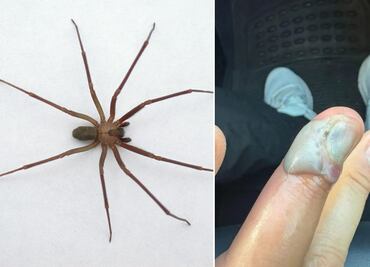 Negligencia médica en Puebla pone en peligro a joven picado por araña violinista