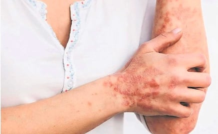 Aumentan contagios de viruela del mono en Puebla, ya van seis casos