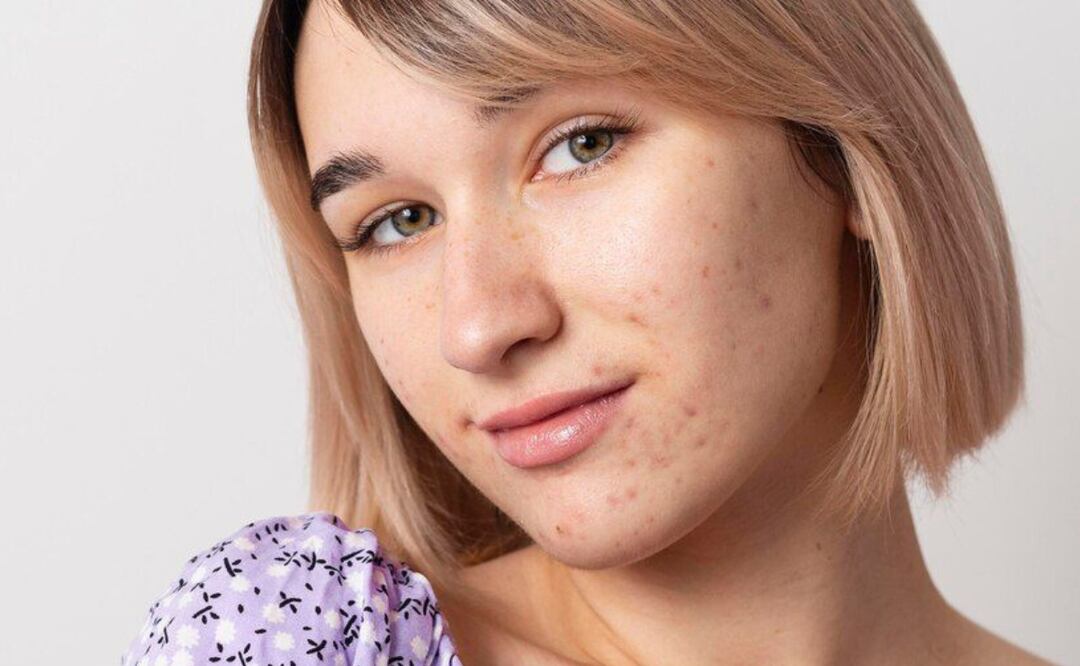 Quita las manchas de la piel con este remedio natural de arroz. Fuente: Freepik.