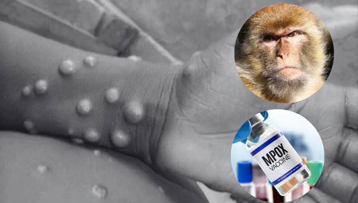 La OMS declaró el brote de mpox | Foto: Especial