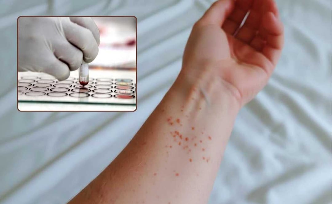 El sarampión es más contagioso que el Covid-19 | Foto: EsImagen/RRSS