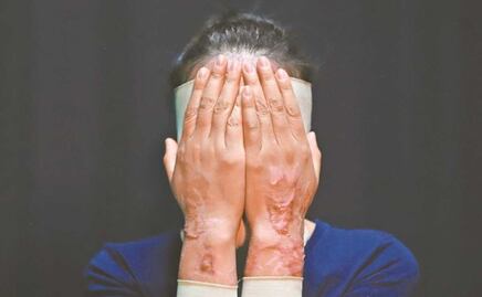 Hay 3 tipos de ácido que ocupan los agresores contra mujeres