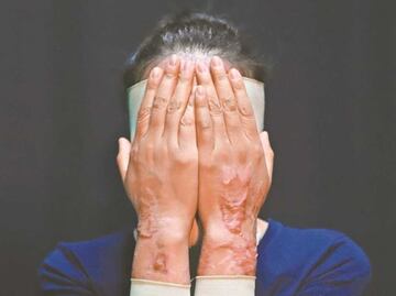 Hay 3 tipos de ácido que ocupan los agresores contra mujeres