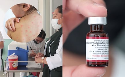 Sarampión en Puebla: van 53 casos; consulta aquí dónde te puedes vacunar