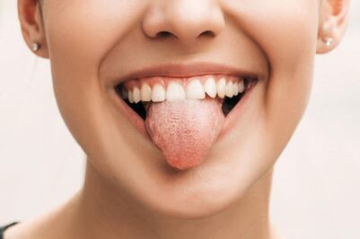 ¿Qué es la lengua blanca? Conoce cómo puedes prevenir la candidiasis oral