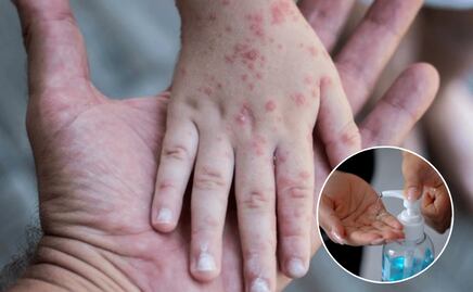 Hay 470 brotes de coxsackie en 66 escuelas de Puebla