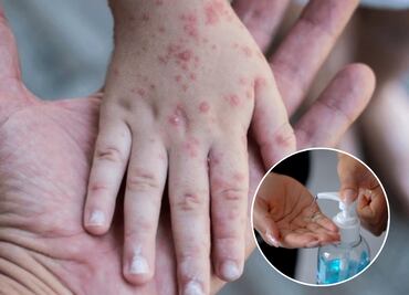 Hay 470 brotes de coxsackie en 66 escuelas de Puebla