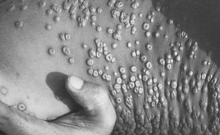 Reportan dos casos sospechosos de viruela símica en Puebla