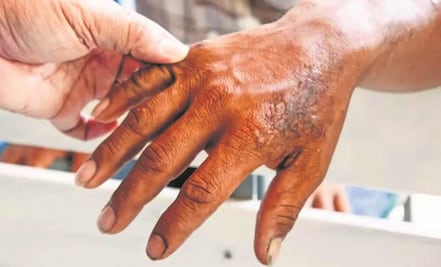 ¿Hay casos de lepra en Puebla?, esto es lo que se sabe