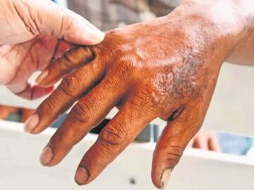 ¿Hay casos de lepra en Puebla?, esto es lo que se sabe