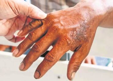 ¿Hay casos de lepra en Puebla?, esto es lo que se sabe