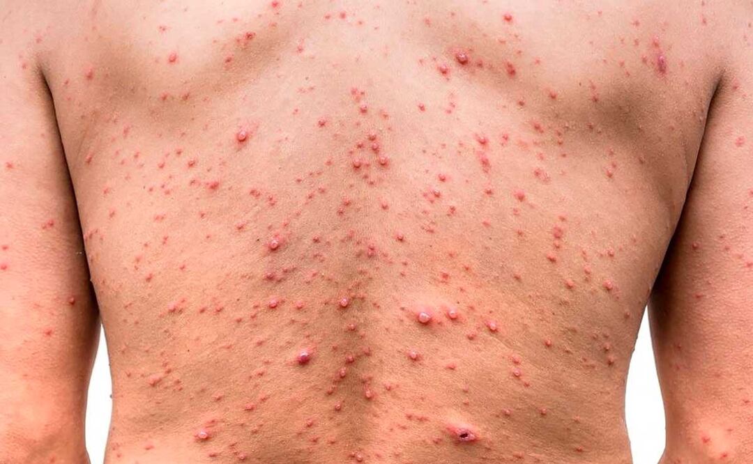 Puebla ocupa el quinto lugar nacional por contagios de viruela símica | Foto: Archivo El Universal