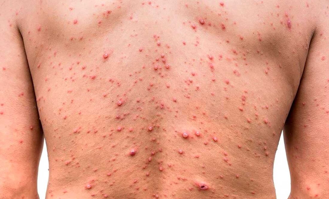 Puebla ocupa el quinto lugar nacional por contagios de viruela símica | Foto: Archivo El Universal