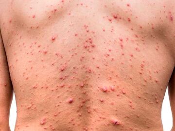 Viruela del mono: Suman 40 casos confirmados por Salud Puebla