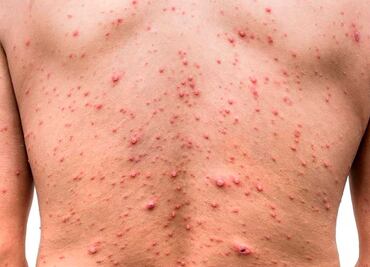 Viruela del mono: Suman 40 casos confirmados por Salud Puebla