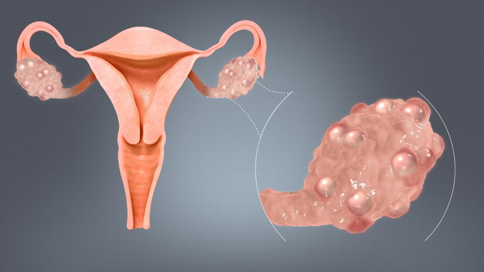 El síndrome de ovario poliquístico (SOP) es un problema crónico, degenerativo e incurable que afecta entre 21 y 22 por ciento de las mujeres mexicanas. 

Foto: Producción El Universal Puebla