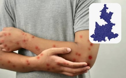 Personas de 25 a 44 años, las más afectadas por sarampión en Puebla