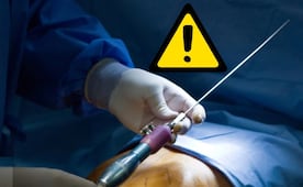 ¿Qué riesgos tiene una liposucción? Lo que debes saber antes de entrar al quirófano