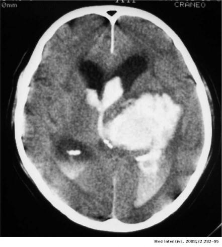 ¿Qué es una hemorragia cerebral y cómo prevenirla?