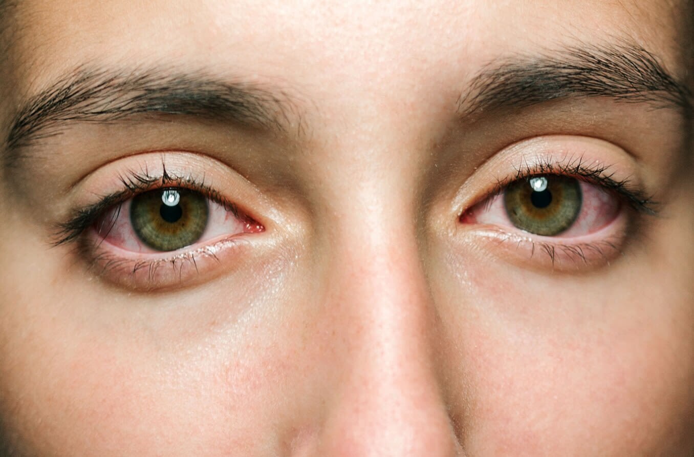 Estos son los síntomas de los ojos secos provocado por la ola de calor