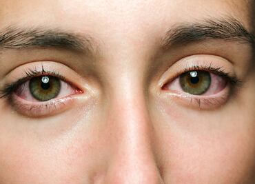 Estos son los síntomas de los ojos secos provocado por la ola de calor