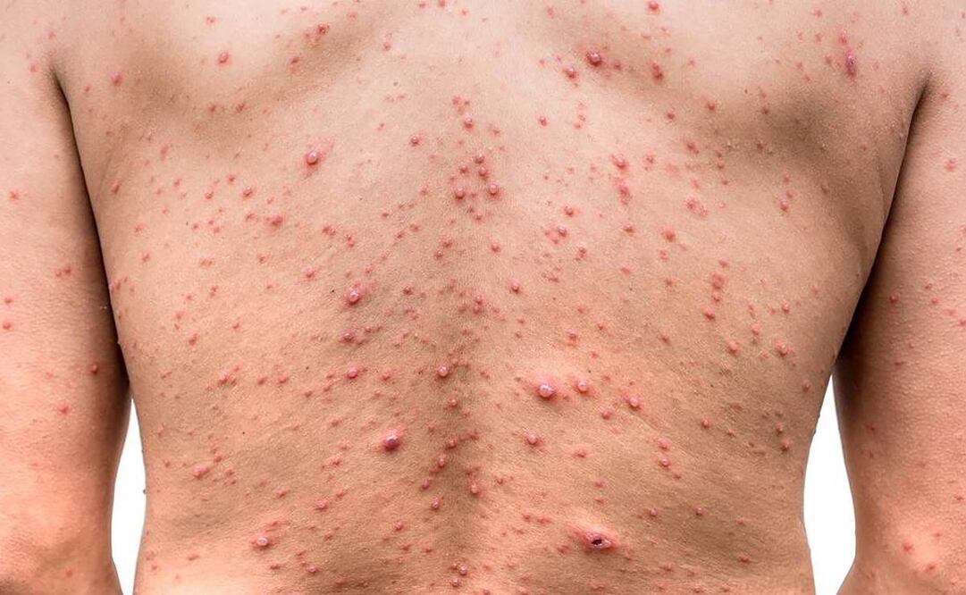 ¿En cuáles países hay casos de viruela del mono?