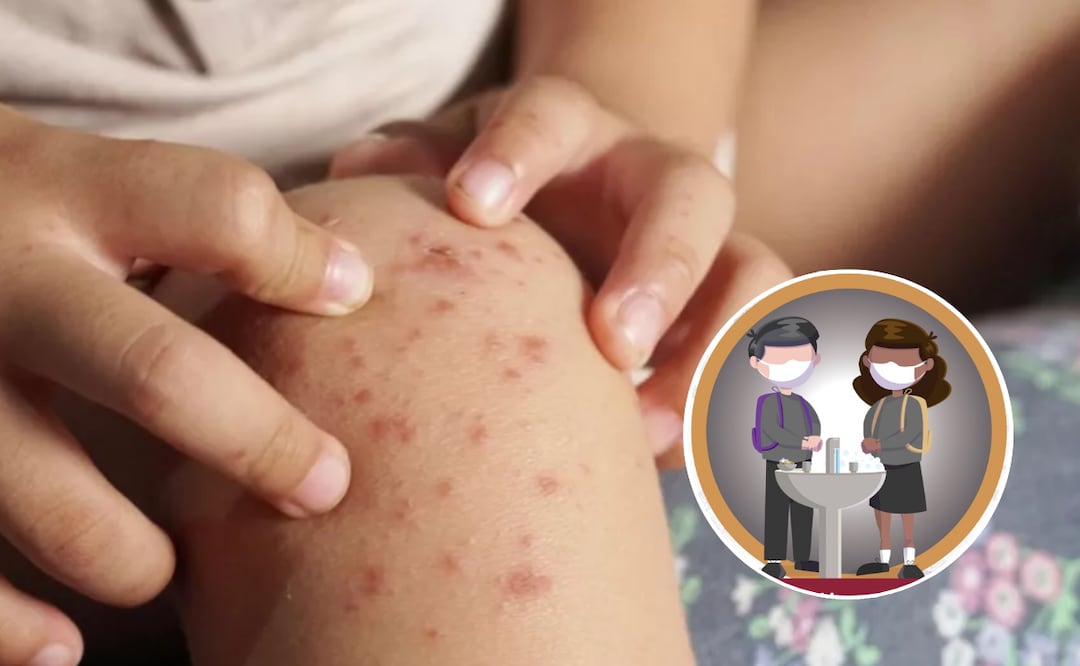 Atiende Gobierno de Puebla brote de virus coxsackie en municipios | Foto: Gobierno de Puebla.