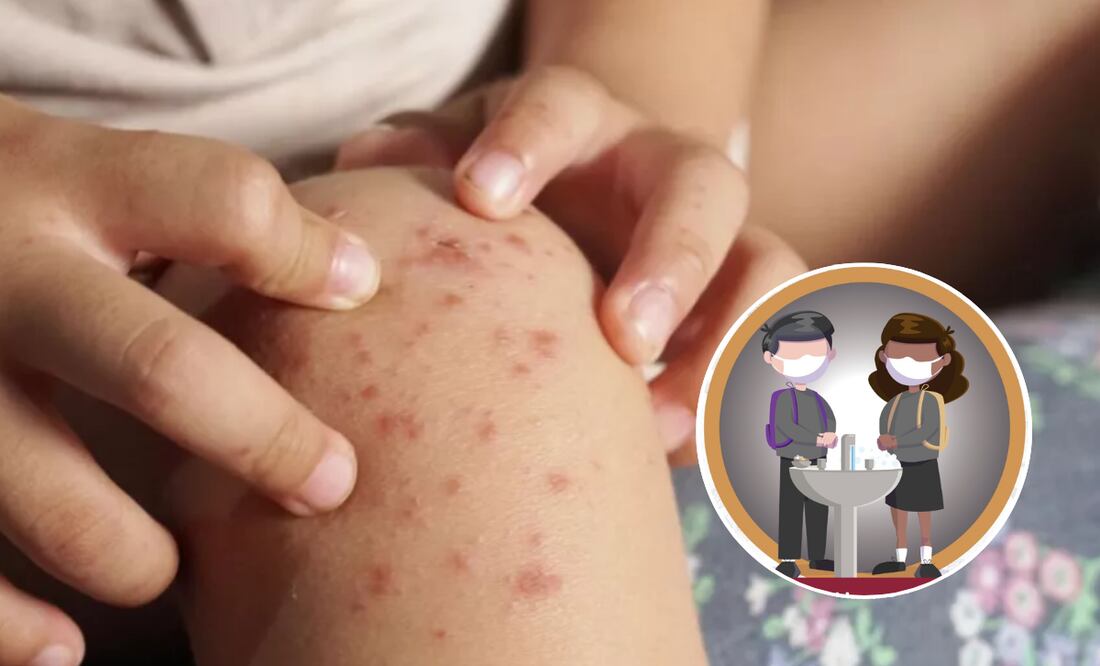 Atiende Gobierno de Puebla brote de virus coxsackie en municipios | Foto: Gobierno de Puebla.