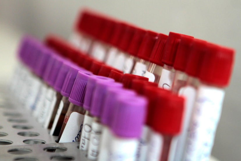 Confirman 4 casos de sarampión en Puebla, Salud establece cerco sanitario