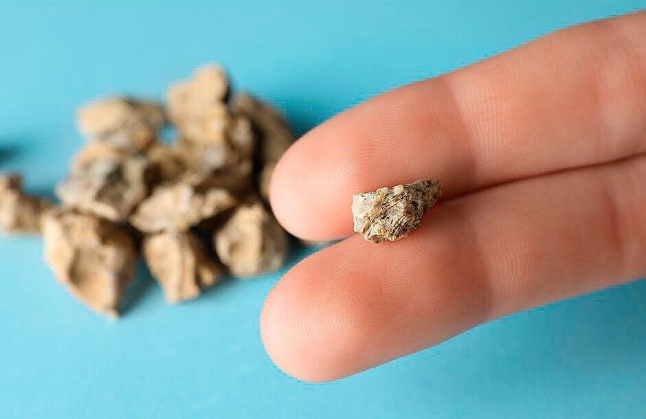 Estos cálculos pueden desarrollarse en cualquier parte de las vías urinarias, desde los riñones hasta la vejiga. Se forman cuando la orina se concentra, permitiendo que los minerales se cristalicen y se agrupen.

Foto: Producción El Universal Puebla